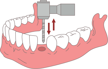 The extraction site heals and bone stabilizes.