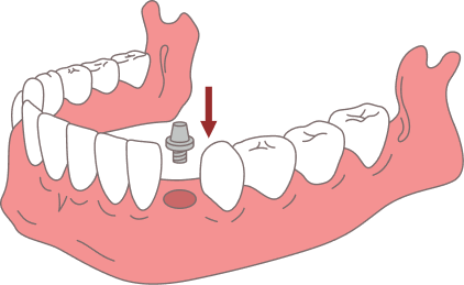 The implant fuses with the bone