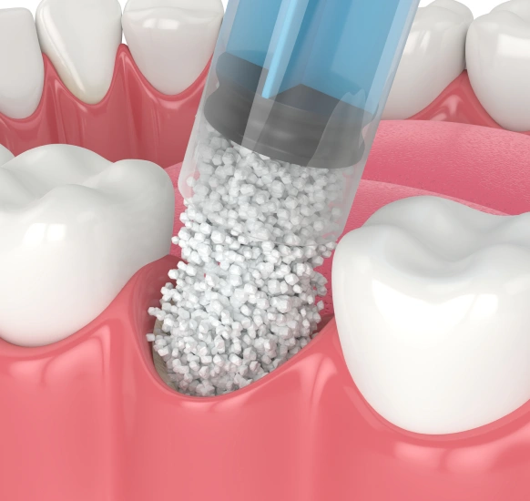 Dental bone graft procedure showing graft material added to an area of bone loss