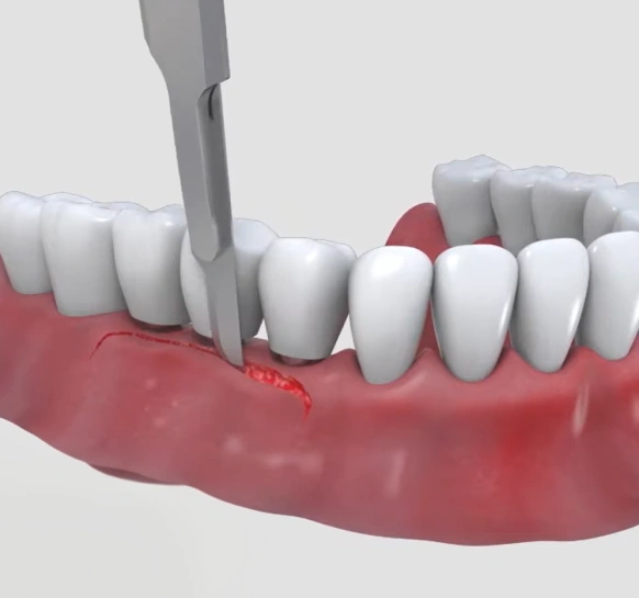 Autogenous bone graft procedure illustration for dental implant placement