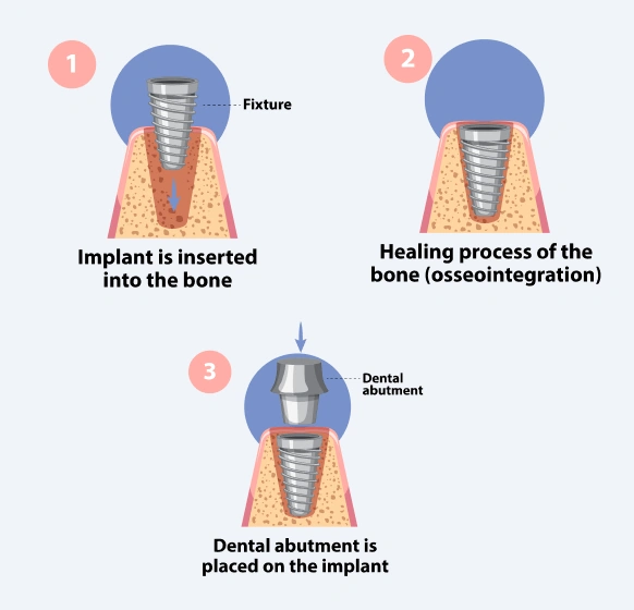 Bone grafting procedure for dental implants in jawbone illustration