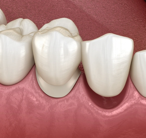 Crown lengthening procedure exposing more tooth structure for restoration