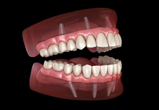 Full mouth dental implants with ball attachment denture restoration