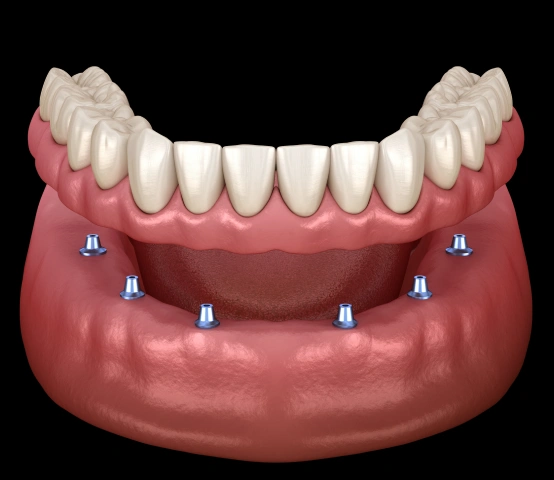Full mouth dental implants with conus restoration denture attachment