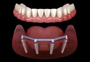 Full mouth implant retained upper denture for complete smile restoration