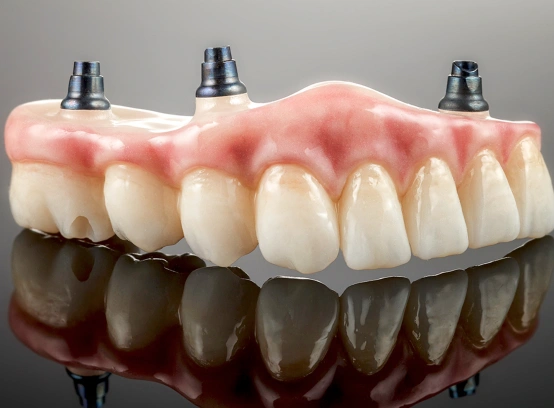 Full mouth dental implants with screw retained denture hybrid restoration