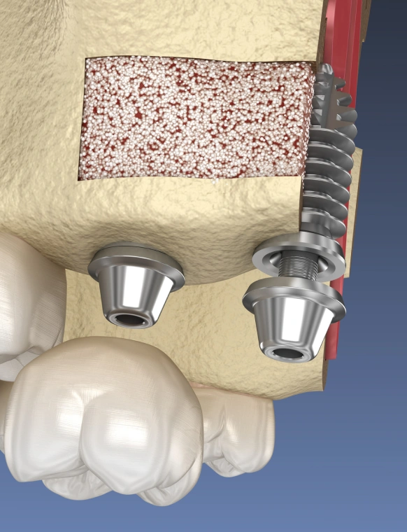 Guided bone and tissue regeneration procedure for dental implant placement