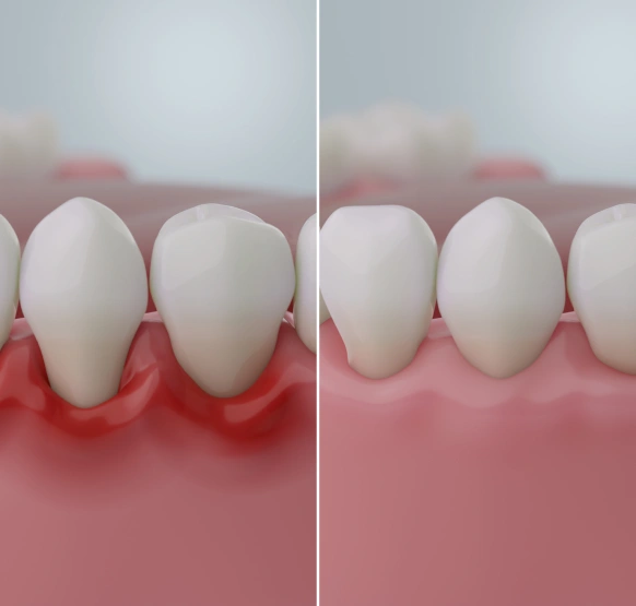 Gum disease progression showing infected and inflamed gum tissue