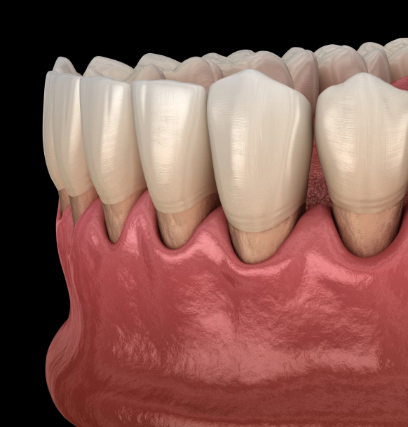 Gum grafting procedure to restore receding gum tissue around teeth