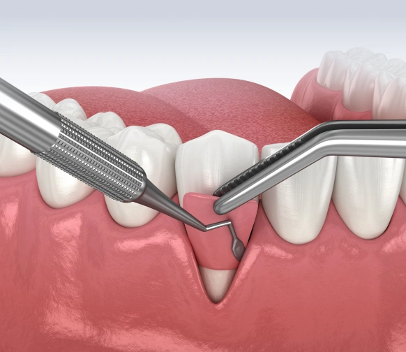 Gum pocket reduction surgery to treat advanced periodontal disease