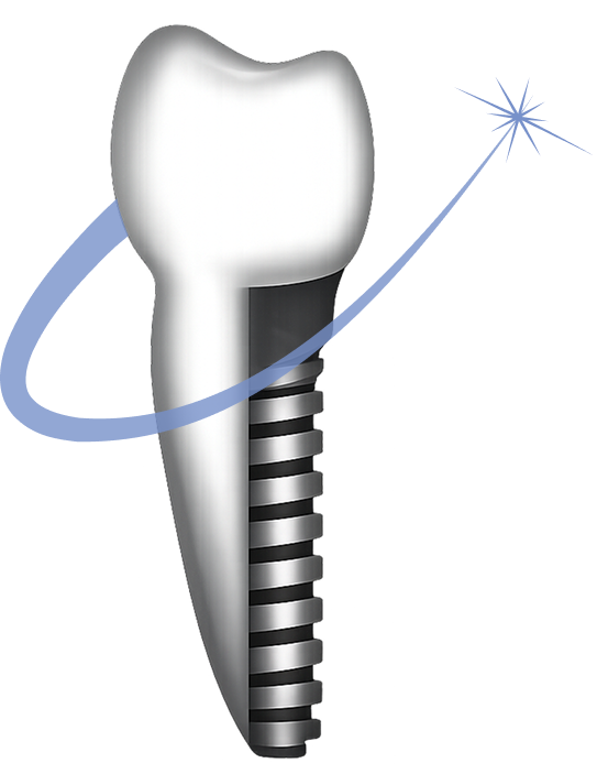 Graphic illustration of a dental implant tooth with a blue swoosh and sparkle.