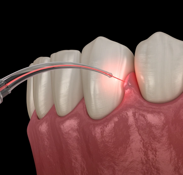Laser Assisted New Attachment Procedure