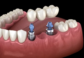 Two dental implants with abutments placed in the lower jaw
