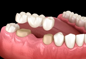 Fixed dental bridge replacing missing teeth in lower jaw