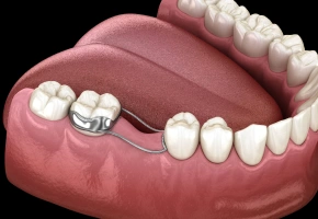 Dental flipper removable partial denture replacing missing lower teeth