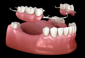 Metal partial denture for replacing multiple missing teeth