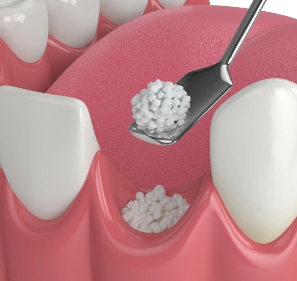 Non-autogenous bone graft procedure illustration for dental implants