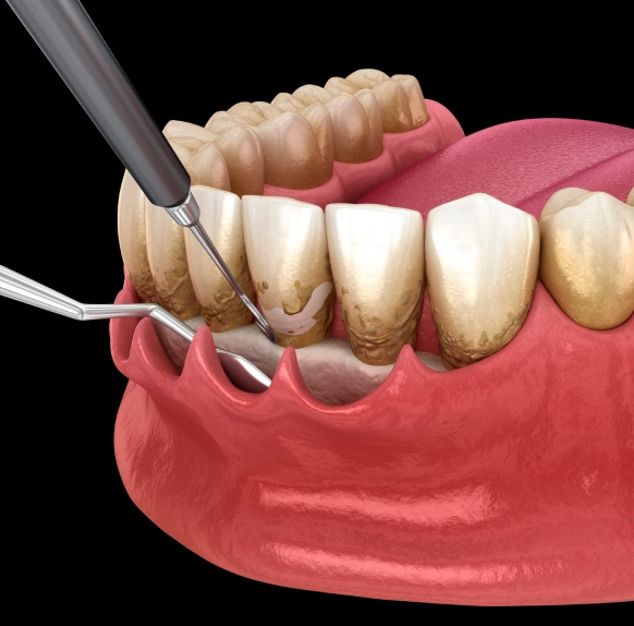 Dental instrument performing pinhole surgical technique on gum tissue