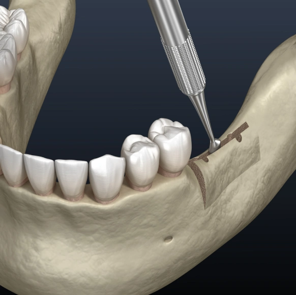 Ridge augmentation procedure to rebuild jawbone for dental implants