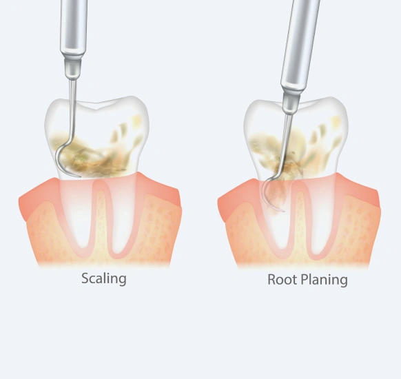 Scaling and root planing deep cleaning treatment for gum disease