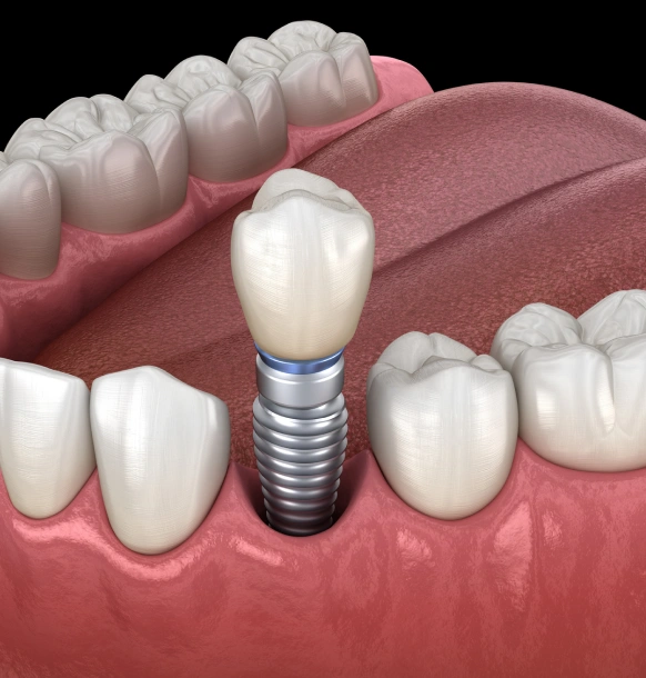 Single tooth dental implant placement process in jawbone illustration
