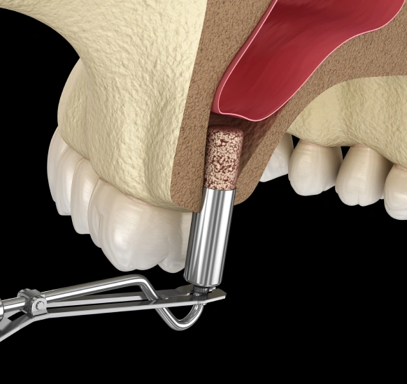 Sinus augmentation bone grafting procedure for upper jaw implants