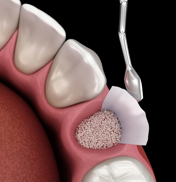 Socket preservation procedure after tooth extraction for future implant