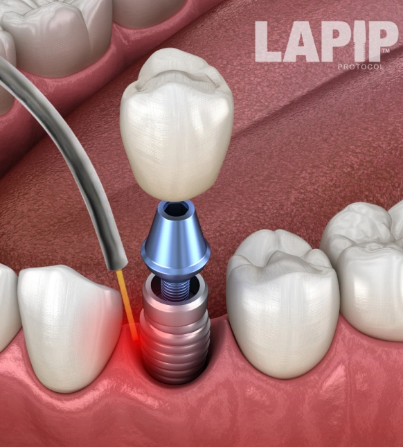 Dental implant with laser treatment shown in a detailed dental illustration