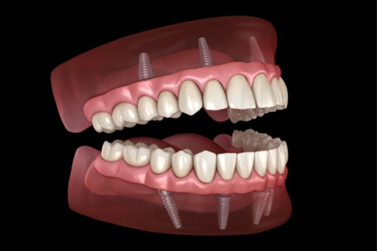 Full mouth dental implants treatment in Virginia Beach