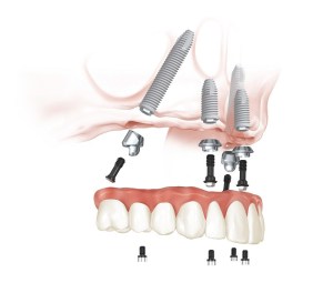 All-on-4 image diagram side angle