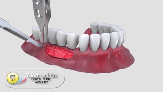 Free Gingival Graft thumbnail